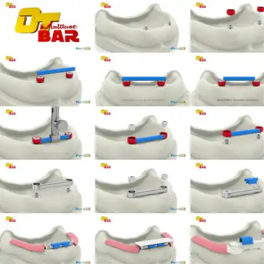 Dụng cụ và Phụ kiện RHEIN83 | Broken Screw Extractor Kit
